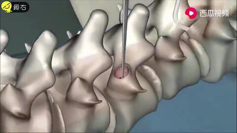 成人还能矫正脊柱吗视频,揭秘矫正可能性与方法